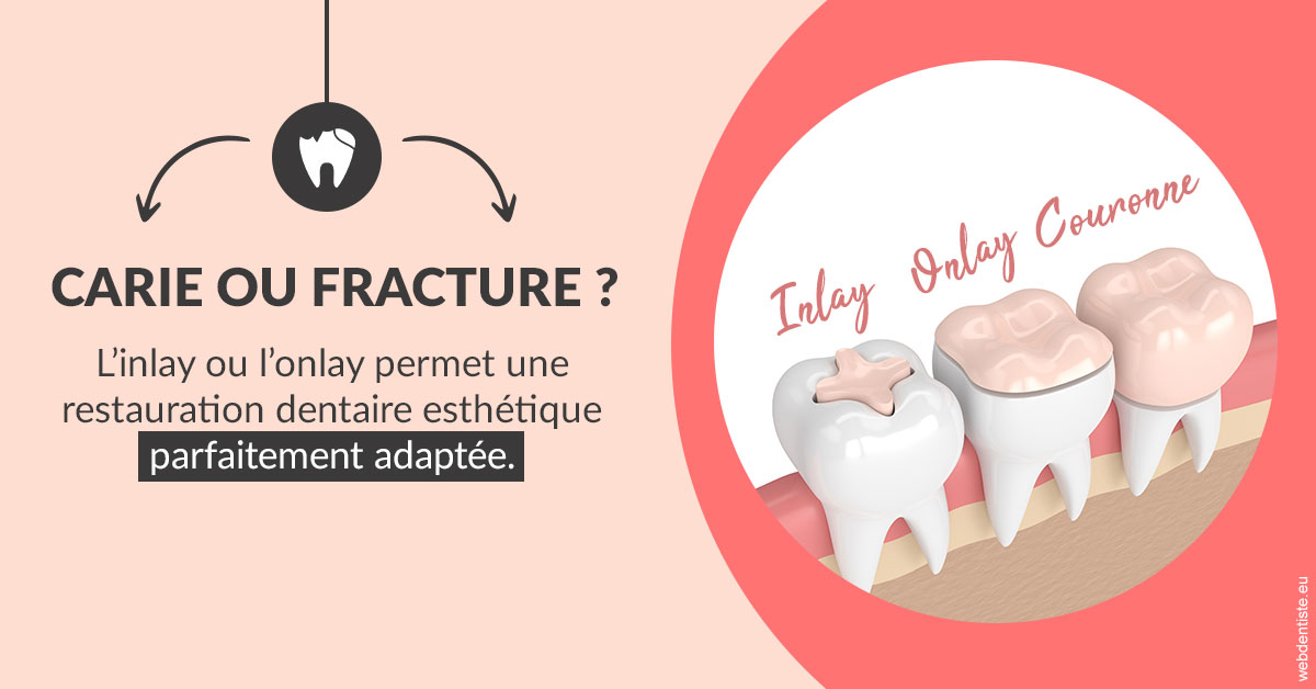 https://selarl-dr-fauquet-roure-coralie.chirurgiens-dentistes.fr/T2 2023 - Carie ou fracture 2