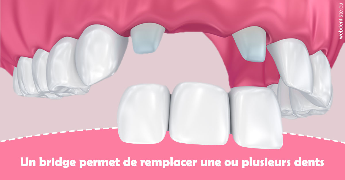 https://selarl-dr-fauquet-roure-coralie.chirurgiens-dentistes.fr/Bridge remplacer dents 2