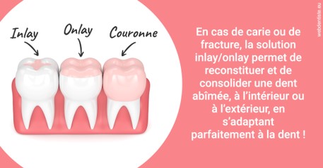 https://selarl-dr-fauquet-roure-coralie.chirurgiens-dentistes.fr/L'INLAY ou l'ONLAY 2