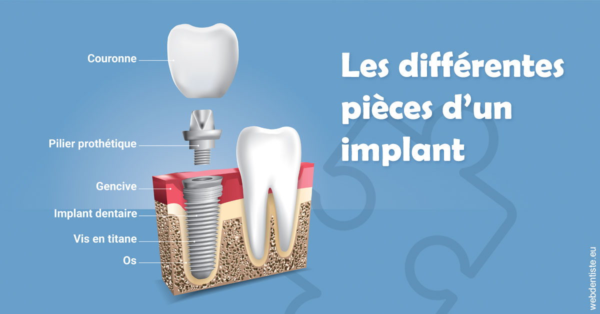 https://selarl-dr-fauquet-roure-coralie.chirurgiens-dentistes.fr/Les différentes pièces d’un implant 1